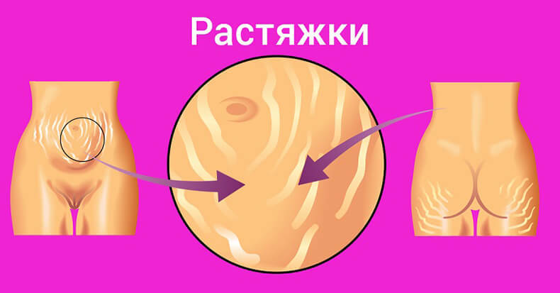 РАССТЯЖКИ: Копеечное средство из аптеки, которое выровняет кожу