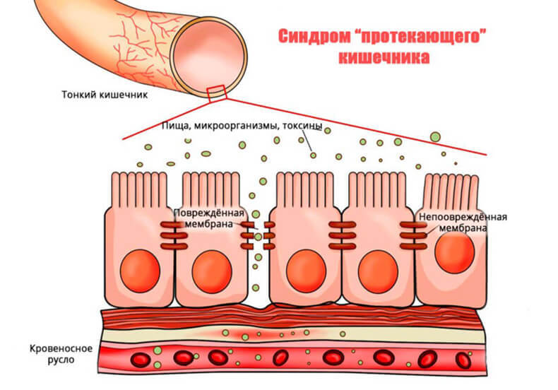 ПРОБЛЕМНАЯ КОЖА и «Синдром Дырявого Кишечника»