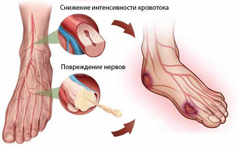 ДИАБЕТИЧЕСКАЯ СТОПА: симптомы и лечение