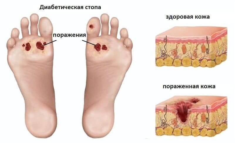 ДИАБЕТИЧЕСКАЯ СТОПА: симптомы и лечение