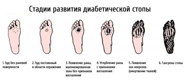 ДИАБЕТИЧЕСКАЯ СТОПА: симптомы и лечение