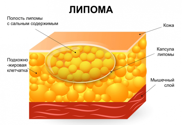 ЛИПОМА не образуется при здоровой печени