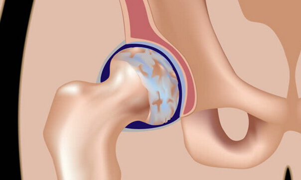 ОСТЕОАРТРИТ тазобедренного сустава: Полезные стратегии 