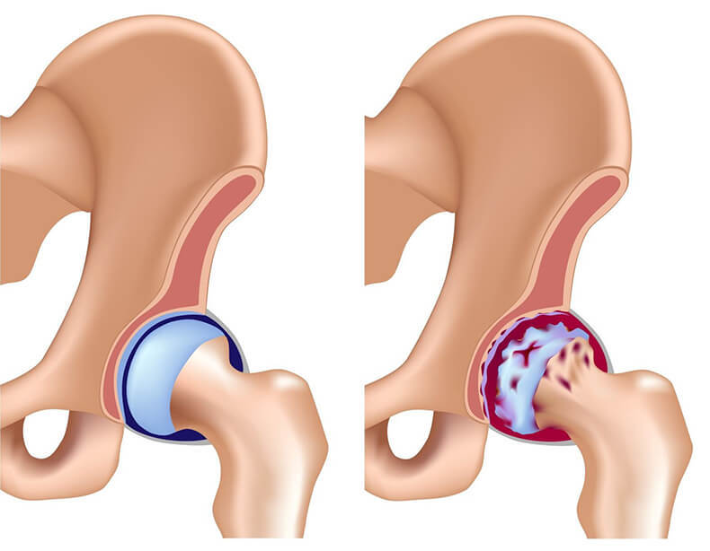 Коксартроз тазобедренного сустава: упражнения и методы лечения