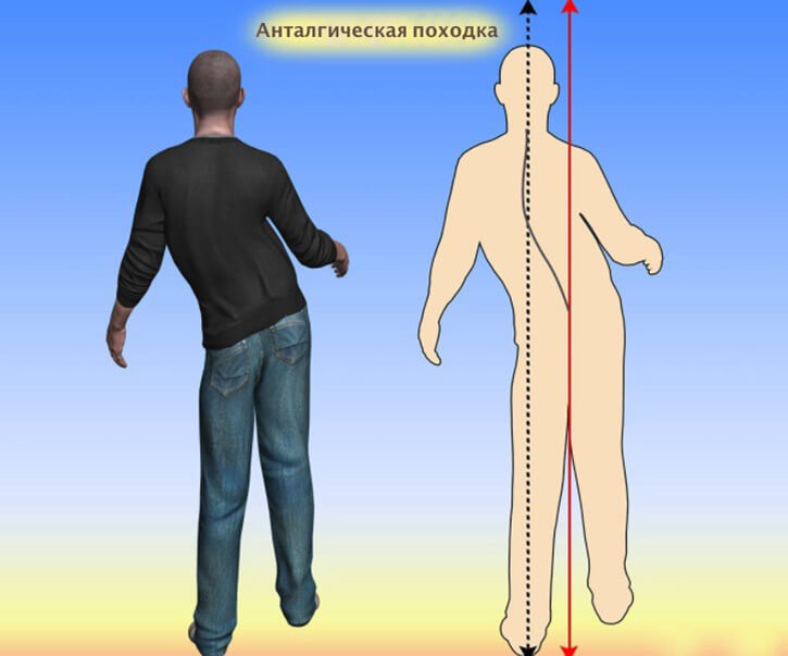 Анталгическая походка: ЧТО ДЕЛАТЬ