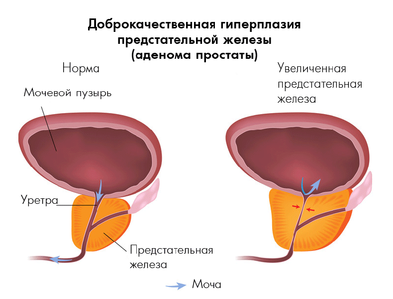 КАК ИЗБАВИТЬСЯ ОТ ПРОСТАТИТА: Упражнения при аденоме простаты