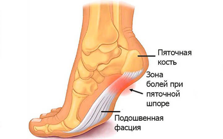 ПЯТОЧНАЯ ШПОРА: УПРАЖНЕНИЕ для СНЯТИЯ БОЛИ