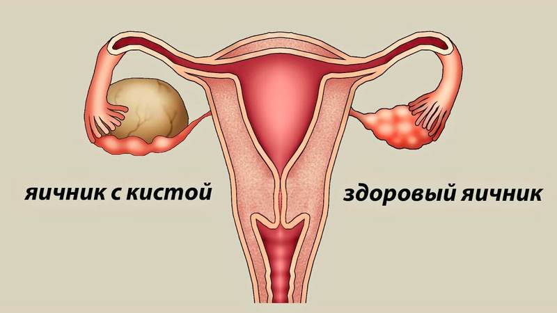 КИСТА ЯИЧНИКА: симптомы и лечение