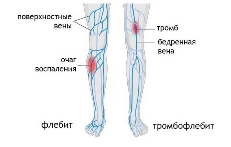 Флебит: 3 средства для лечения воспаления вен