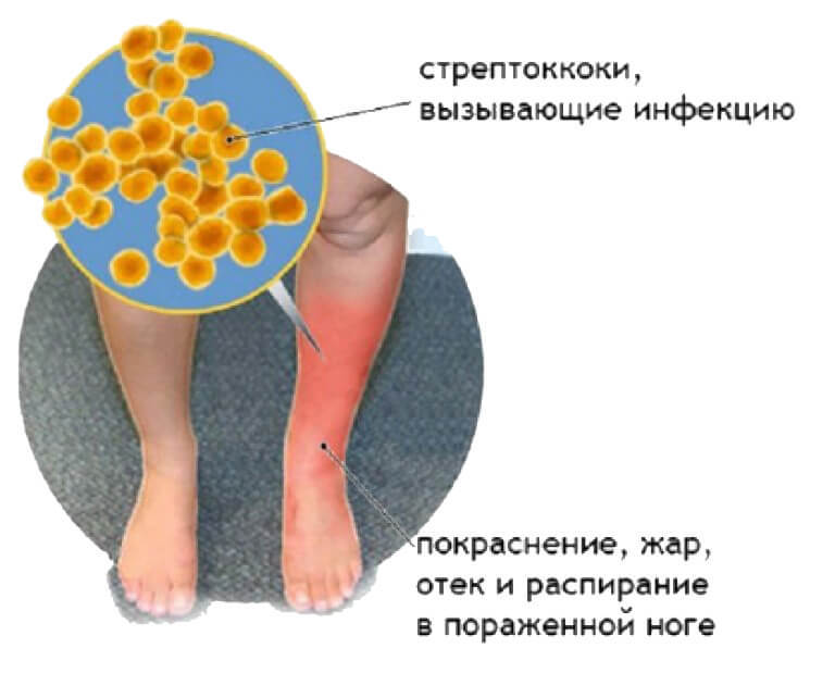 РОЖА – болезнь молодых мужчин и пожилых женщин