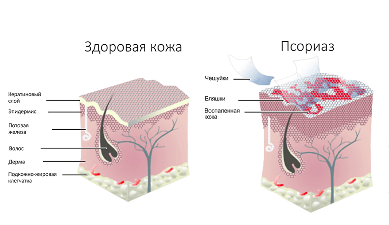 ПСОРИАЗ: натуральный рецепт для лечения