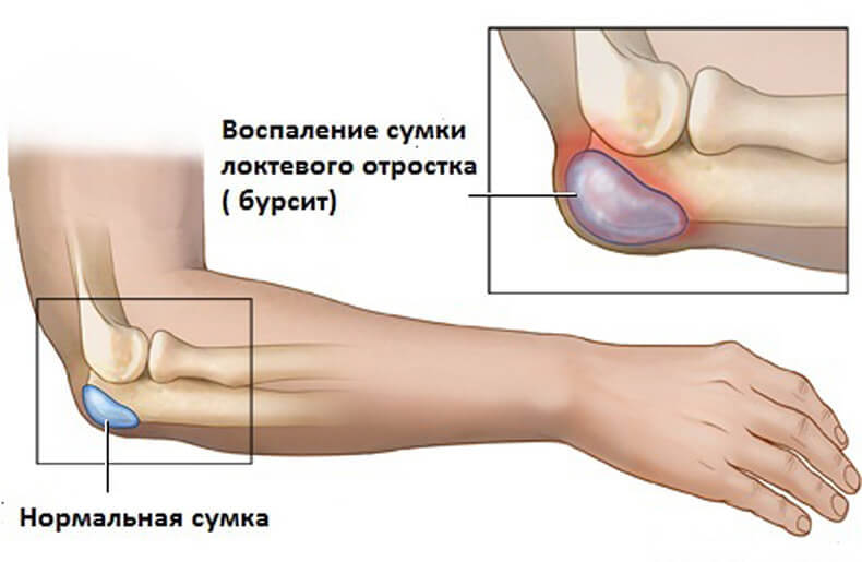 БУРСИТ: Как уменьшить воспаление