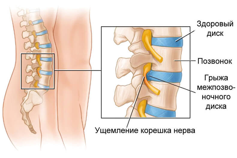 Межпозвонковая грыжа: Когда грыжа становится опасной