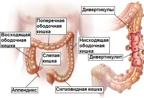 Дивертикулит и дивертикулез: Как вылечить кишечник