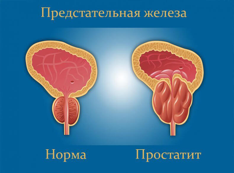 ПРОСТАТИТ: 10 упражнения, которые помогут