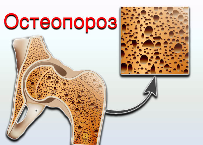 ОСТЕОПОРОЗ: ЧТО НЕОБХОДИМО ЗНАТЬ ЖЕНЩИНАМ 50+
