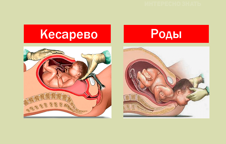  Мишель Оден: Почему врачи все чаще прибегают к кесареву сечению