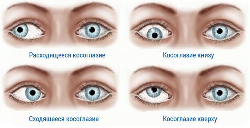 Двоение в глазах: Причины и методы лечения 