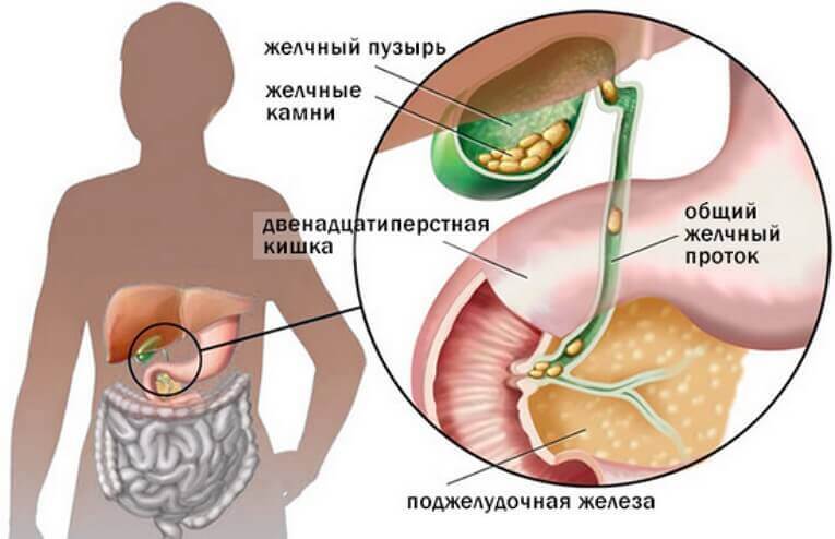 Холецистит. Желчный пузырь удалять нельзя и вот почему