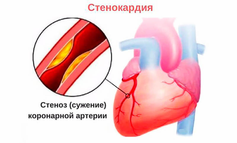 Грудная жаба: Первая помощь при приступе стенокардии