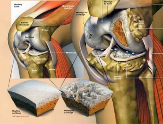 Артроз коленного сустава: Важное о заболевании 