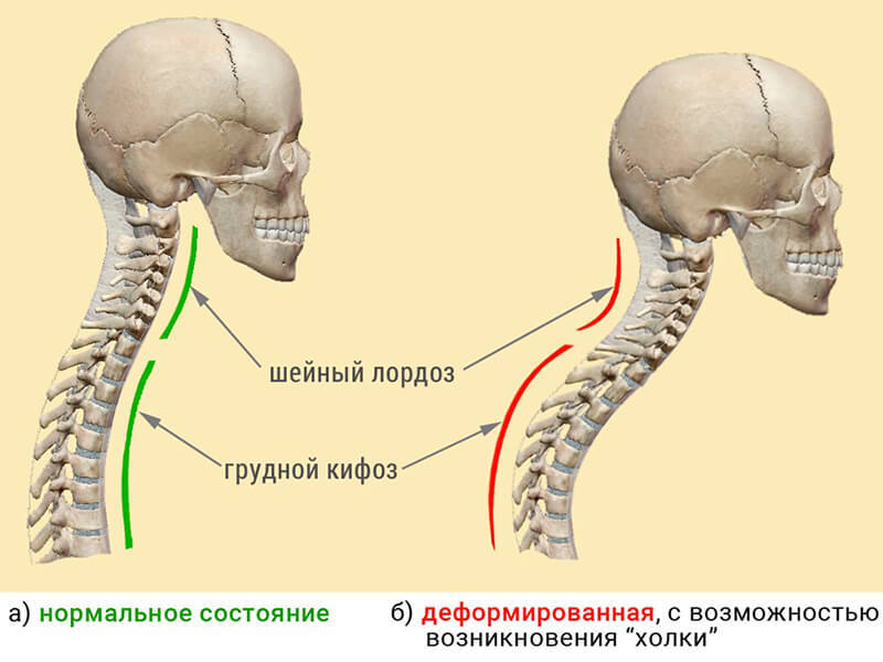 Упражнения Виталия Гитта от кифоза и лордоза 