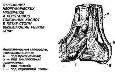 Шпоры и образования в суставах: Тест Брэгга на заизвесткованность