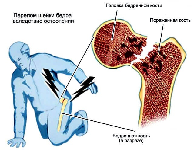 Остеопения: Коварная болезнь с бессимптомным течением 