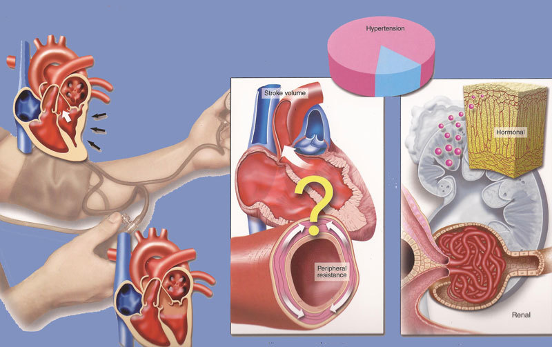 Почки и гипертония: В чем связь