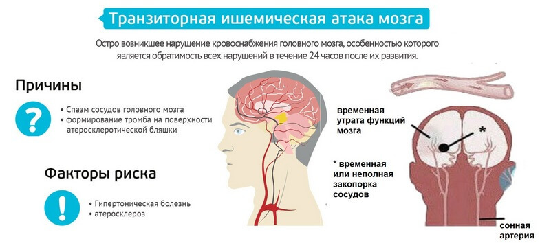 Транзиторная ишемическая атака: Что важно знать   