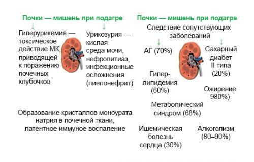 ПОДАГРА: Как быстро снять острую боль во время приступа