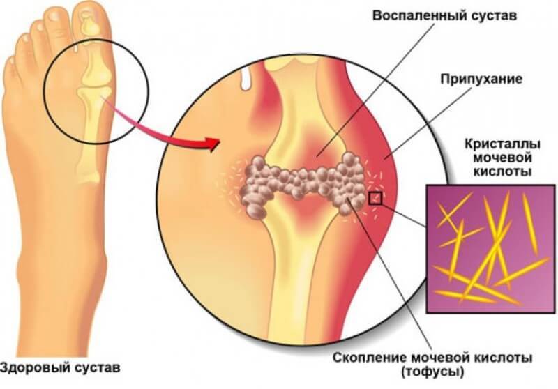 ПОДАГРА: Как быстро снять острую боль во время приступа