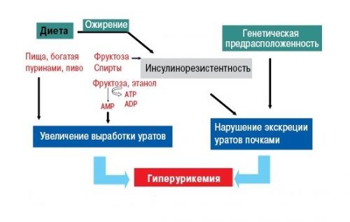 ПОДАГРА: Как быстро снять острую боль во время приступа