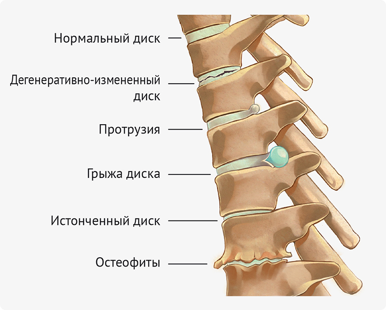 Грудной радикулит: Что можно, а чего нельзя