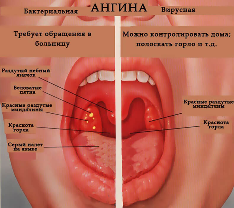 Как лечить ангину: эффективные методы восточной медицины