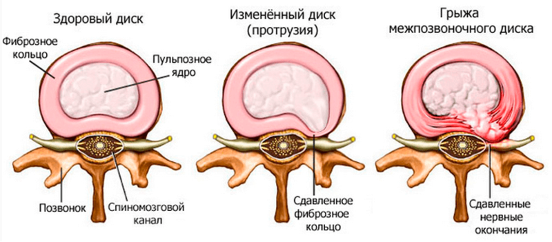 Грыжа поясничного отдела позвоночника: полезные и вредные упражнения