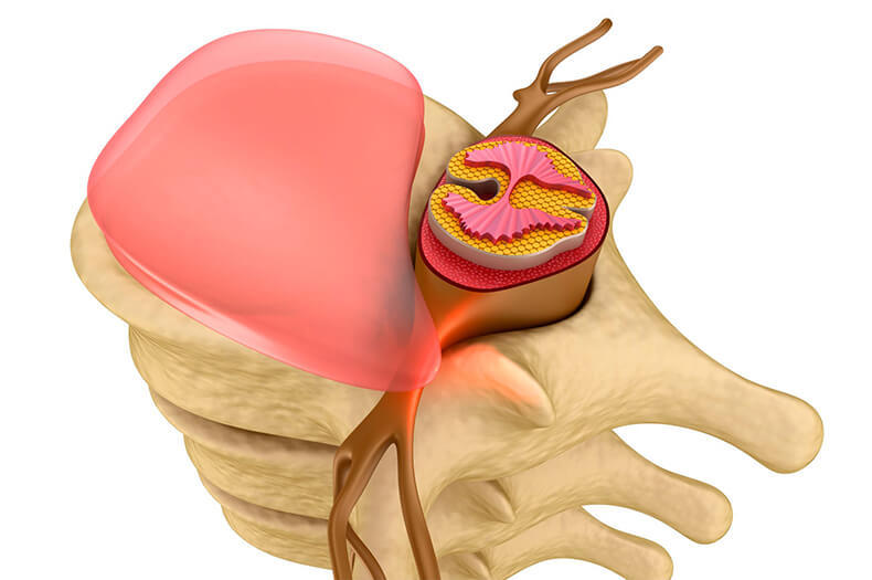 Грыжа поясничного отдела позвоночника: полезные и вредные упражнения