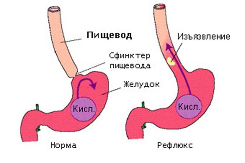 ЭЗОФАГИТ: 10 главных симптомов