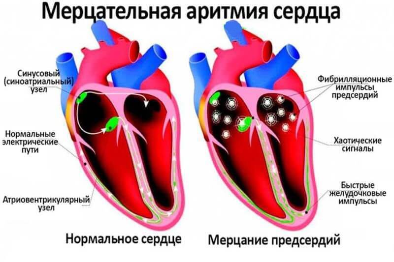 Мерцательная АРИТМИЯ: Что делать