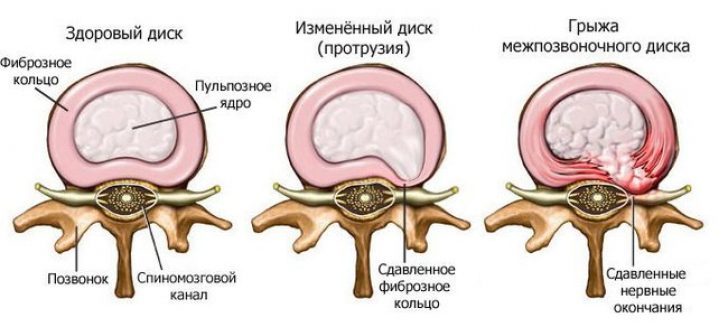 Межпозвонковая ГРЫЖА: Лечение народными средствами