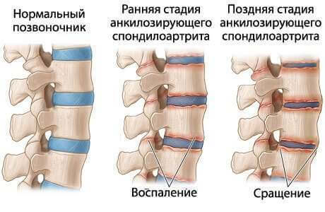 Болезнь Бехтерева: Режим, диета и лечебное голодание