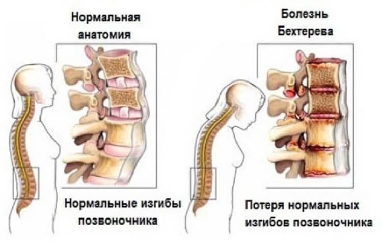 Болезнь Бехтерева: Режим, диета и лечебное голодание