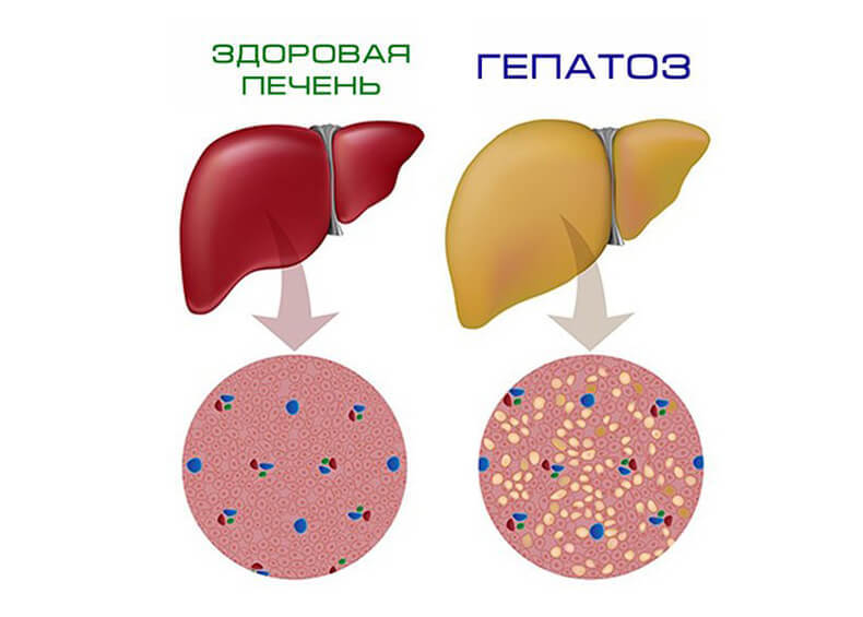 ЖИРОВОЙ ГЕПАТОЗ: Как оздоровить печень