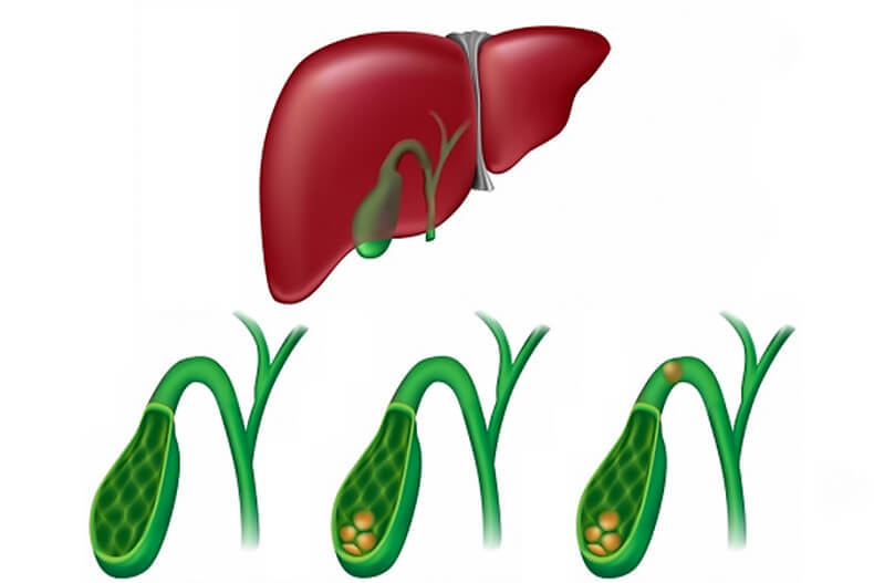 Как лечить желчно-каменную болезнь методами народной медицины