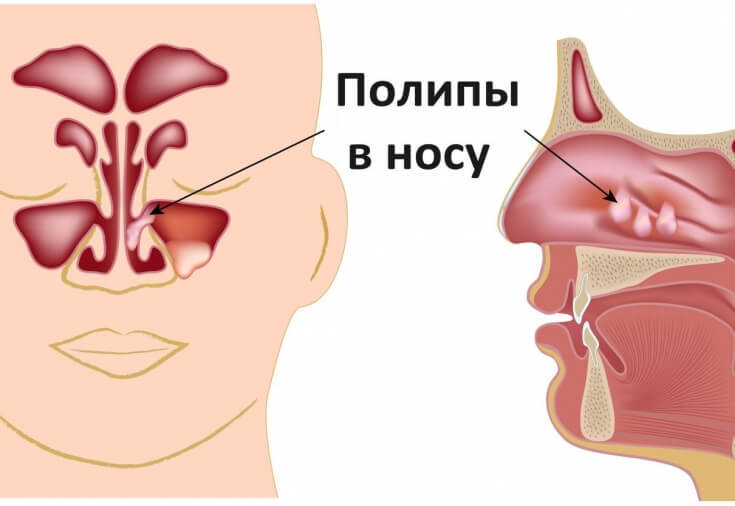 Как избавиться от полипов при помощи натуральных средств