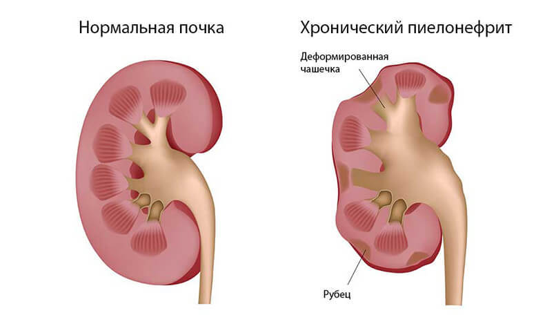 Заболевания ПОЧЕК: Упражнения, которые нормализуют обменные процессы