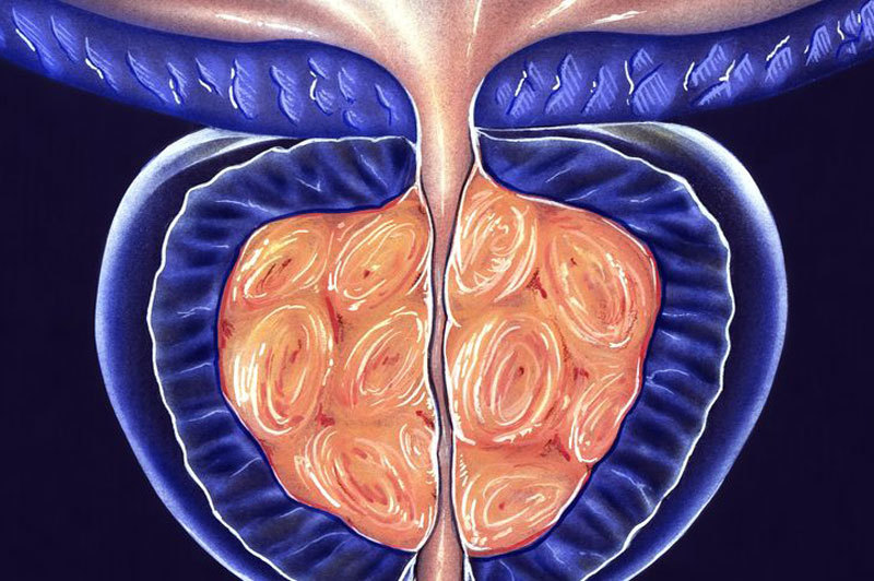 ПРОСТАТИТ: 3 лечебных комплекса при хроническом заболевании