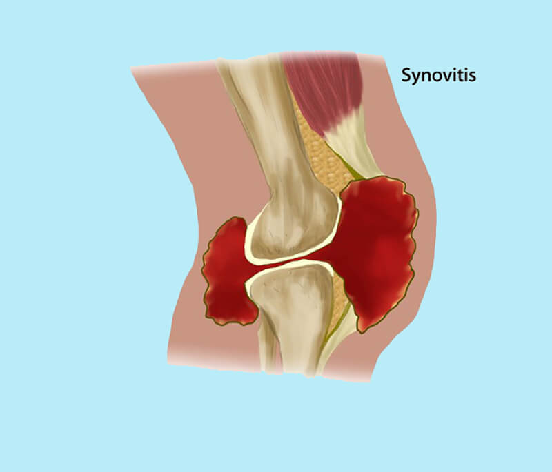 Синовит коленного сустава: Что делать?
