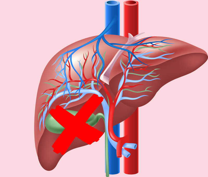 Если НЕТ желчного пузыря: ЧТО можно и что нельзя