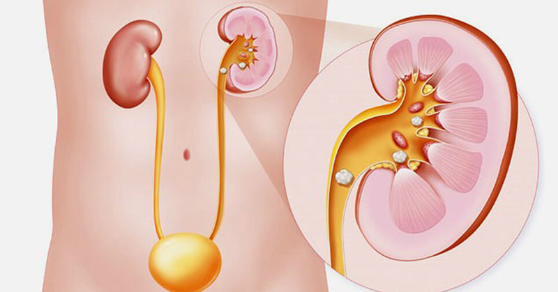 Камни в почках: Как не упустить ранние признаки формирования